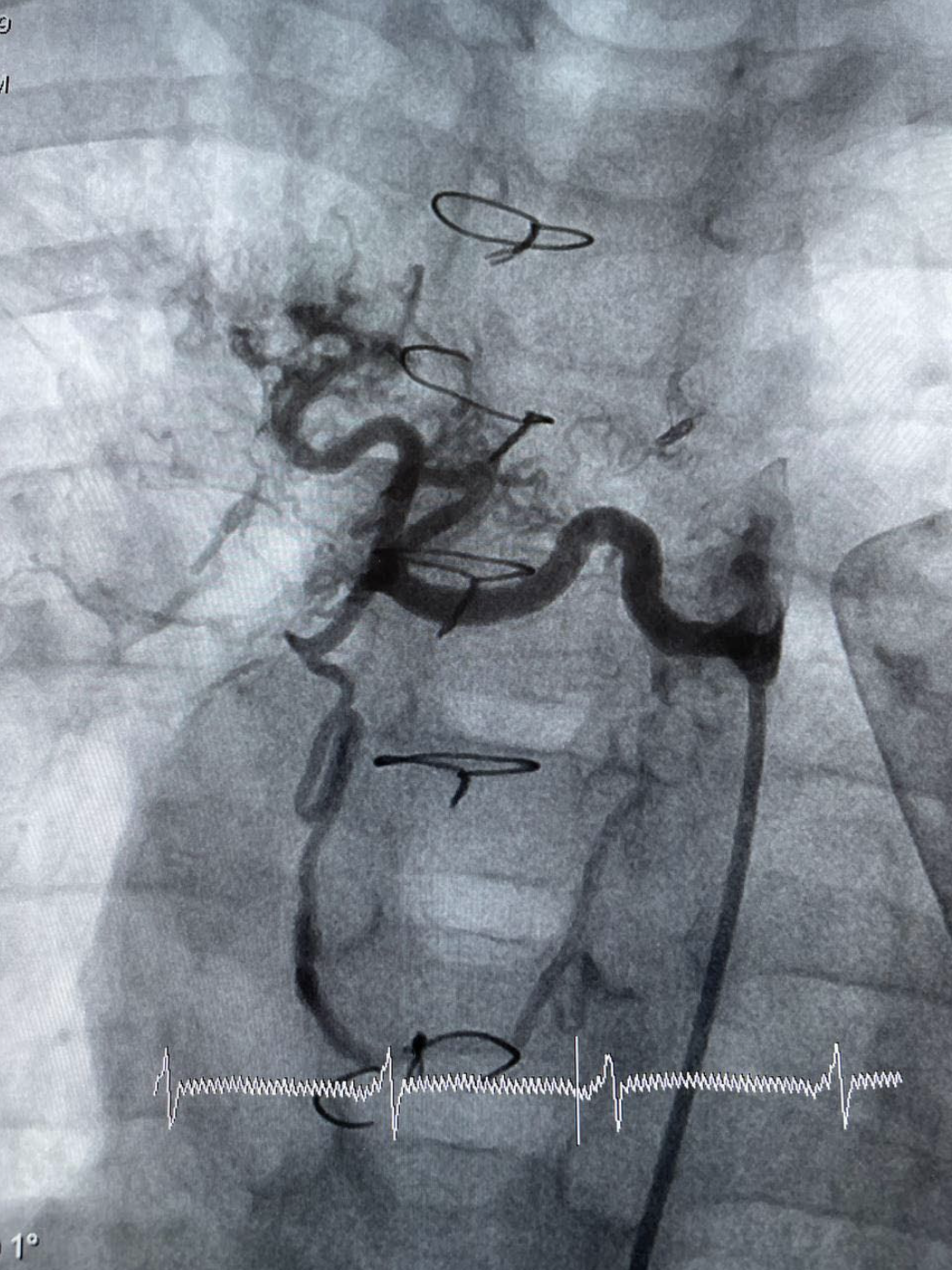 This image is showing a successfully implanted stent