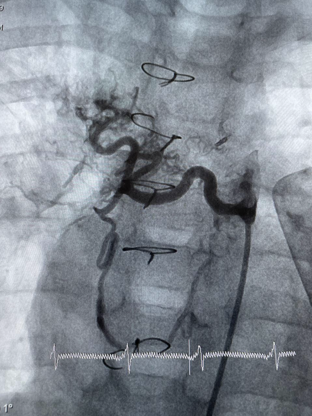 This image is showing a successfully implanted stent This image is showing a successfully implanted stent
